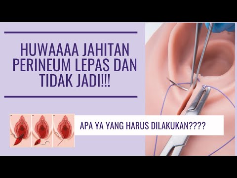 Video: Adakah jahitan perineum sepatutnya berdarah?