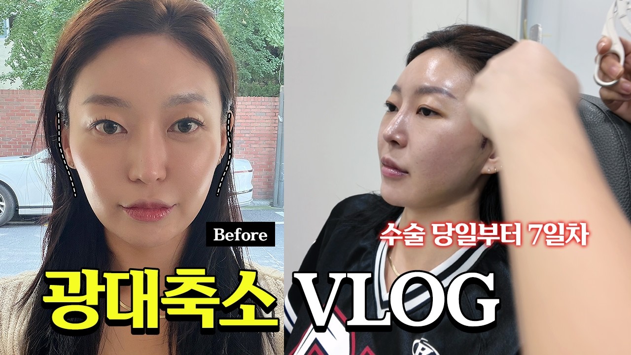 수면광대축소, 실리프팅 ｜ ❣️혜진님의 후기영상❣️ 윤곽수술 당일부터 7일차까지~😎
