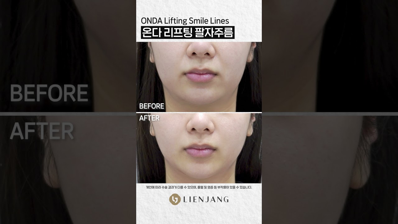 [Риэнжан Гоо Сайхны Мэс Заслын Эмнэлэг] Онда лифтинг хамар амны үрчлээ