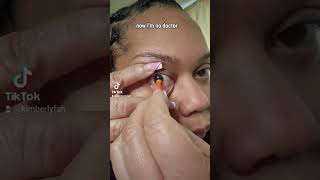 Air Bubbles With Hard Scleral Lenses