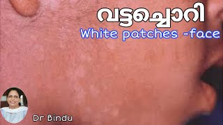 വട്ടച്ചൊറി കുട്ടികൾക്ക് വന്നാൽ/white patches/Fungal infection face/Dr Bindu