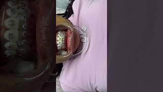 Fashion braces #aesthetic #fashionbraces #teethcleaning #foryou r
