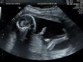 20 week ultrasound its a boy