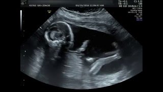 20 week Ultrasound (Its a boy)
