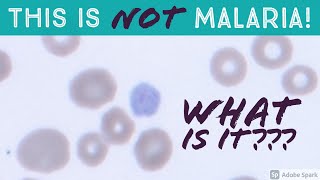 This is NOT Malaria! What is it? An Important Mimic of Plasmodium vivax Gametocyte on Blood Smear screenshot 4