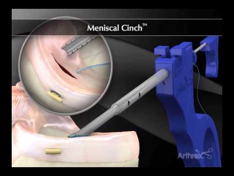 Meniscal Cinch - YouTube