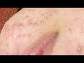 Whiteheads And Pimples Under The Skin | Mụn Ẩn - SacDepSpa#294