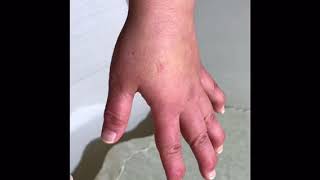 富永ペインクリニック ヘバーデン結節外来