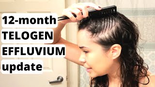 Telogen Effluvium Hair Loss Update Q&A | 10-21-20