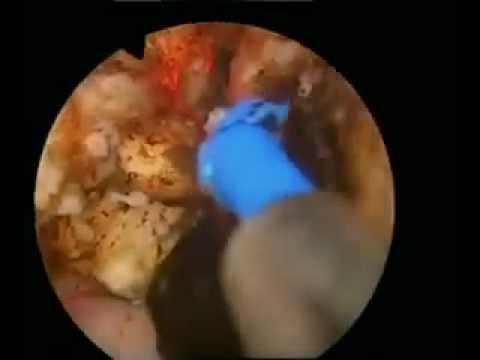 postoperatorio prostata sacca catetere fuoriuscita urinated