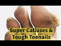 Super Calluses and Tough Toenails
