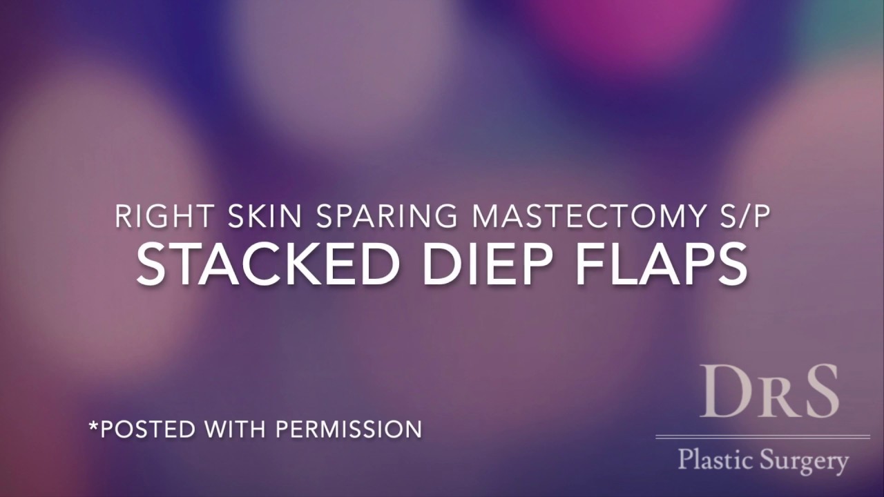 Stacked DIEP flaps for Mastectomy Breast Reconstruction YouTube