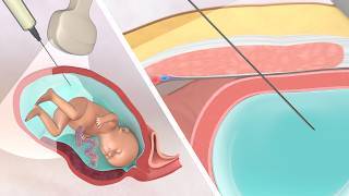 Invasive Testing: Amniocentesis | TVASurg