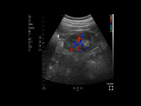 Kidney vessels · Color Doppler · C5SH · 3.5 MHz scan preview