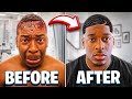 THE REVEAL OF DAMIEN&#39;S SURGICAL HAIRLINE **SHOCKING RESULTS**