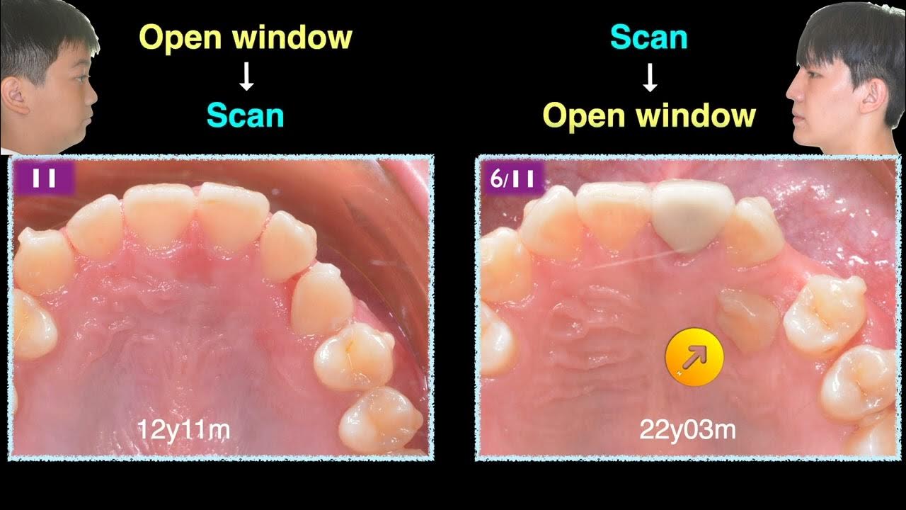 Palatal impaction surgical exposure or alignment by aligners first