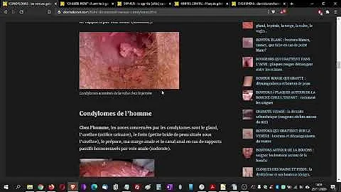 Comment eliminer des condylomes ?