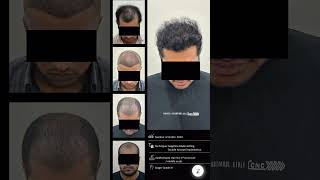 Precision Hair Transplant Evolution: 12-Month Results at Zuri Skin Clinic