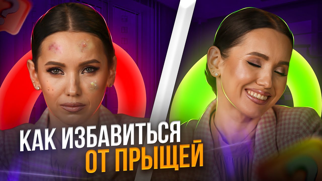 АКНЕ — причины и лечение ПРЫЩЕЙ в домашних условиях!