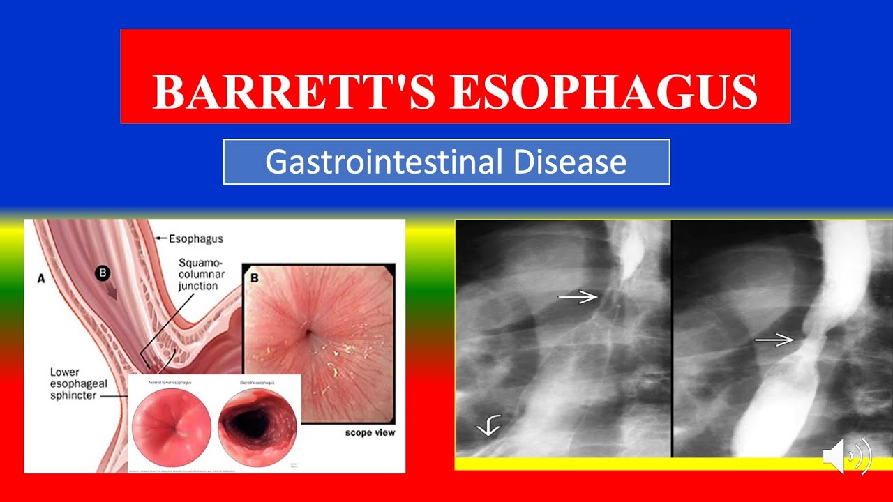 BARRETT'S ESOPHAGUS - Definition, types, causes, pathophysiology ...
