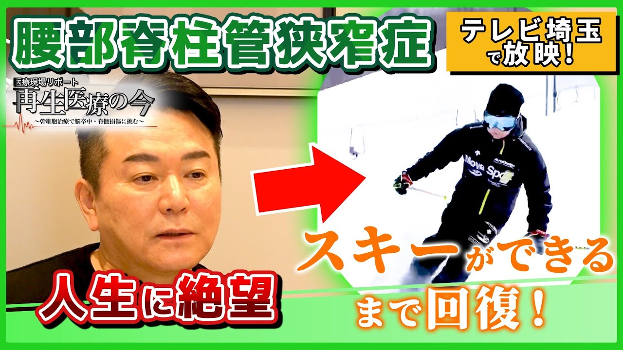 【腰部脊柱管狭窄症・再生医療】テレビ埼玉『医療の現場リポート・再生医療の今』で放映！スキーも再開！腰部脊柱管狭窄症患者様の症例紹介です！