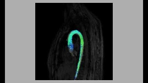 4D MRI Phase-Contrast Image (Real Blood Flow)