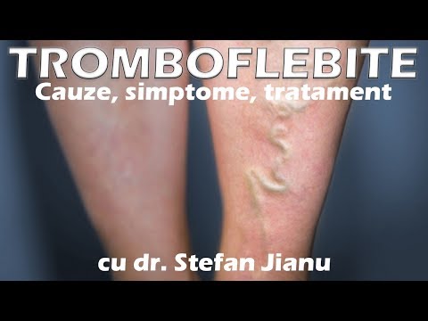 Video: Tromb în Picior - Cauze, Simptome și Tratament