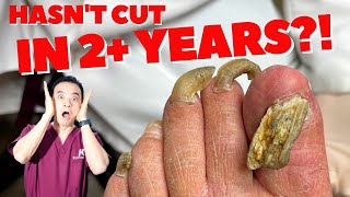 CUTTING AND GRINDING DOWN LONG THICK NAILS (SUPER CRUNCHY!!) | Dr. Kim, Kim Foot and Ankle