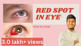 Blood spot in eye reasons |How to treat blood spot in eye | Subconjunctival haemorrhage