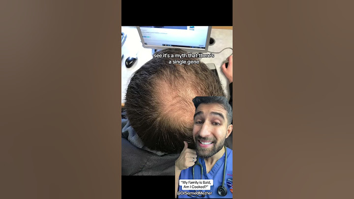 “My Family is Bald, Am I Cooked?” #maybe