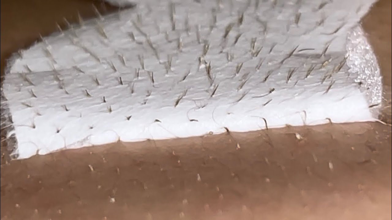 角 栓 背中