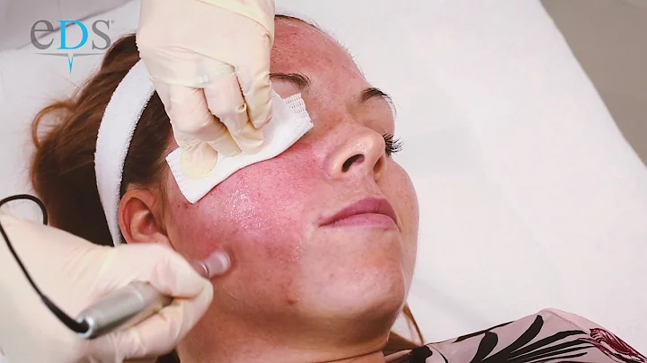 EDS Treatment Video