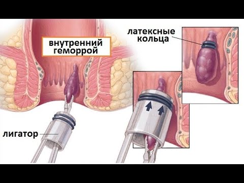 "Кольца" на геморрой. Лигирование геморроидальных узлов.