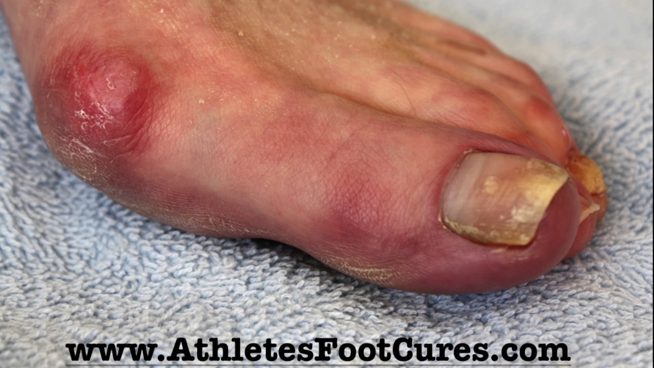 Athlete's Foot Cure: Best Athlete's foot Treatments that get rid of fungus fast - YouTube