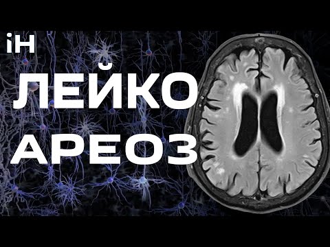 Что такое лейкоареоз? | iНЕВРОЛОГ