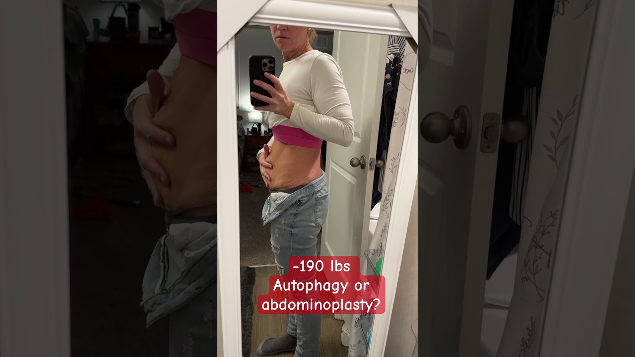 Would you get abdominoplasty or keep working on autophagy? -190lbs #carnivore #glp1 #gastricybypass