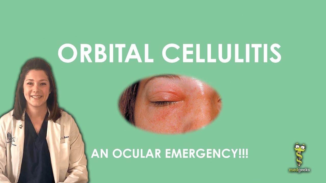 periorbital cellulitis contagious