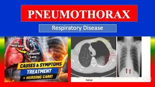 PNEUMOTORAKS - Definisi, jenis, penyebab, patofisiologi, gejala, diagnosis, pengobatan screenshot 3