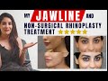 Nonsurgicalrhinoplasty and jawline treatment nose job  cara clinic l dr asif