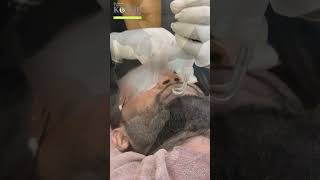 Dark Lips Treatment With Laser | Brighter, Even-Looking Lips | The Kosme Care
