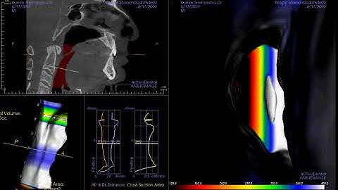 Airway Analysis With INVIVO 6