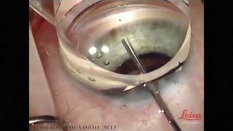Arsham Sheybani, MD, Demonstrates Katena Surgical Gonio Prism
