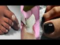Most ugly toenails Transformation 😱 pedicure Transformation #27