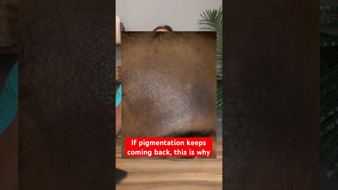 Why Pigmentation & Melasma Never Go Away  