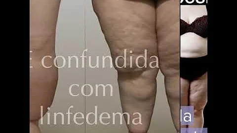 Qual é o tratamento para lipedema?