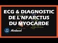 ECG et diagnostic de l'infarctus du myocarde (crise cardiaque)