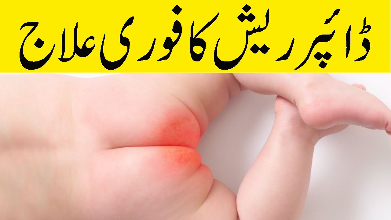 Nappy Rash | Diaper Rash Treatment | Bachon K Rashes Ka Ilaj | Nappy ...