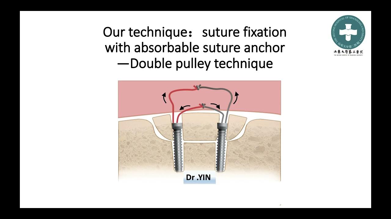 Arthroscopic Suture Fixation of Os Acetabuli With Absorbable Suture