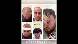 زراعة الشعر من جدة 00905066054217