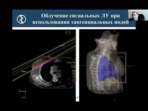 Новиков С.Н. ОФЭКТ/КТ для определения тактики химио-лучевого лечения при раке молочной железы